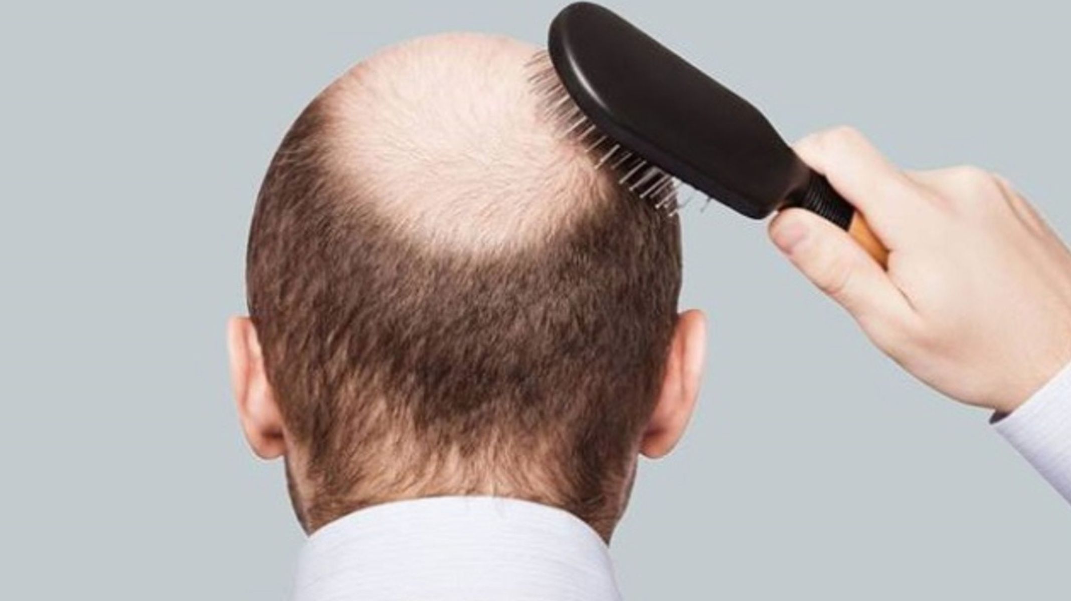 Отзывы врачей выпадение волос. Выпадение волос у мужчин. Лысеющий мужчина.