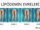 Lipödem İlaçla Tedavi Edilebilir Mi? - RayHaber