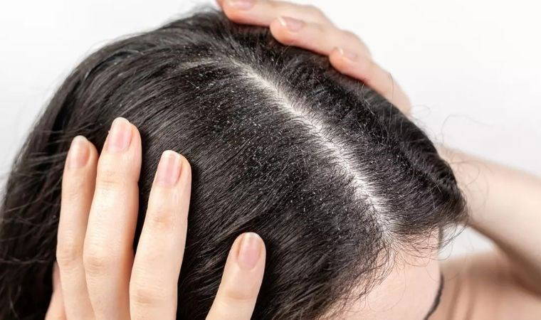 Kepeğe Karşı 7 Doğal Çözüm - RayHaber